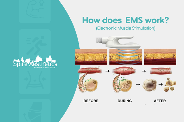 EMS treatment for post pregnancy weight loss treatment Wrexham