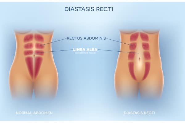 What Non-Surgical Options Are Available for Diastasis Recti Wrexham?