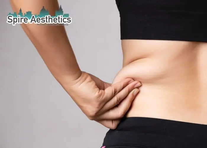 Image of woman pinching fat on their hips Wrexham. Fat Freezing treatment