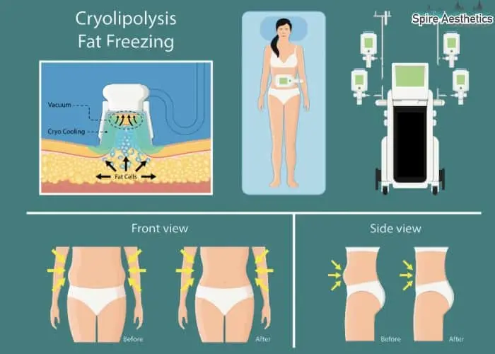 Fat freezing treatment Wrexham benefits for competitions to remove stubborn fat deposits.