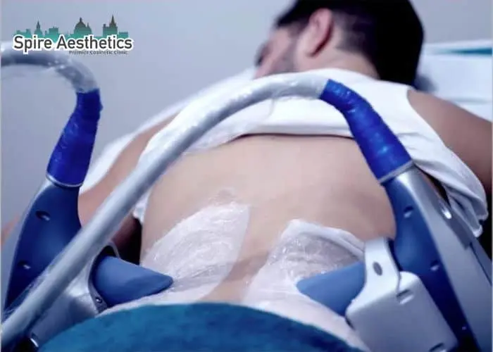Man having fat freezing treatment done on love handles before a competitions Wrexham to create a sculpted look.