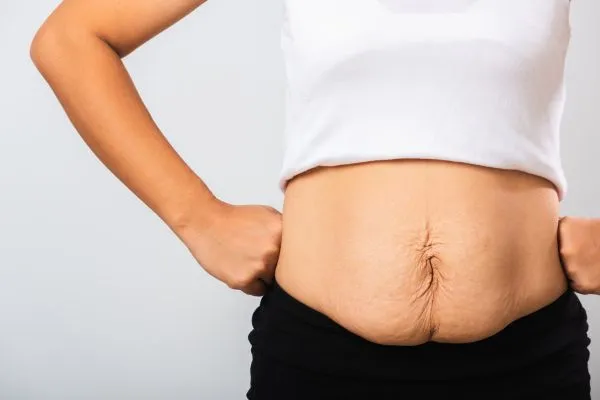 Image of a woman's stomach after weight loss with sagging skin following a gastric band Wrexham