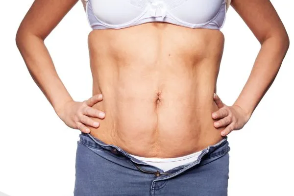sagging skin on woman's stomach after weight loss injections Wrexham