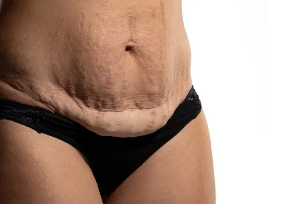 Image of womans stomach after weight loss injections Wrexham showing saggy skin