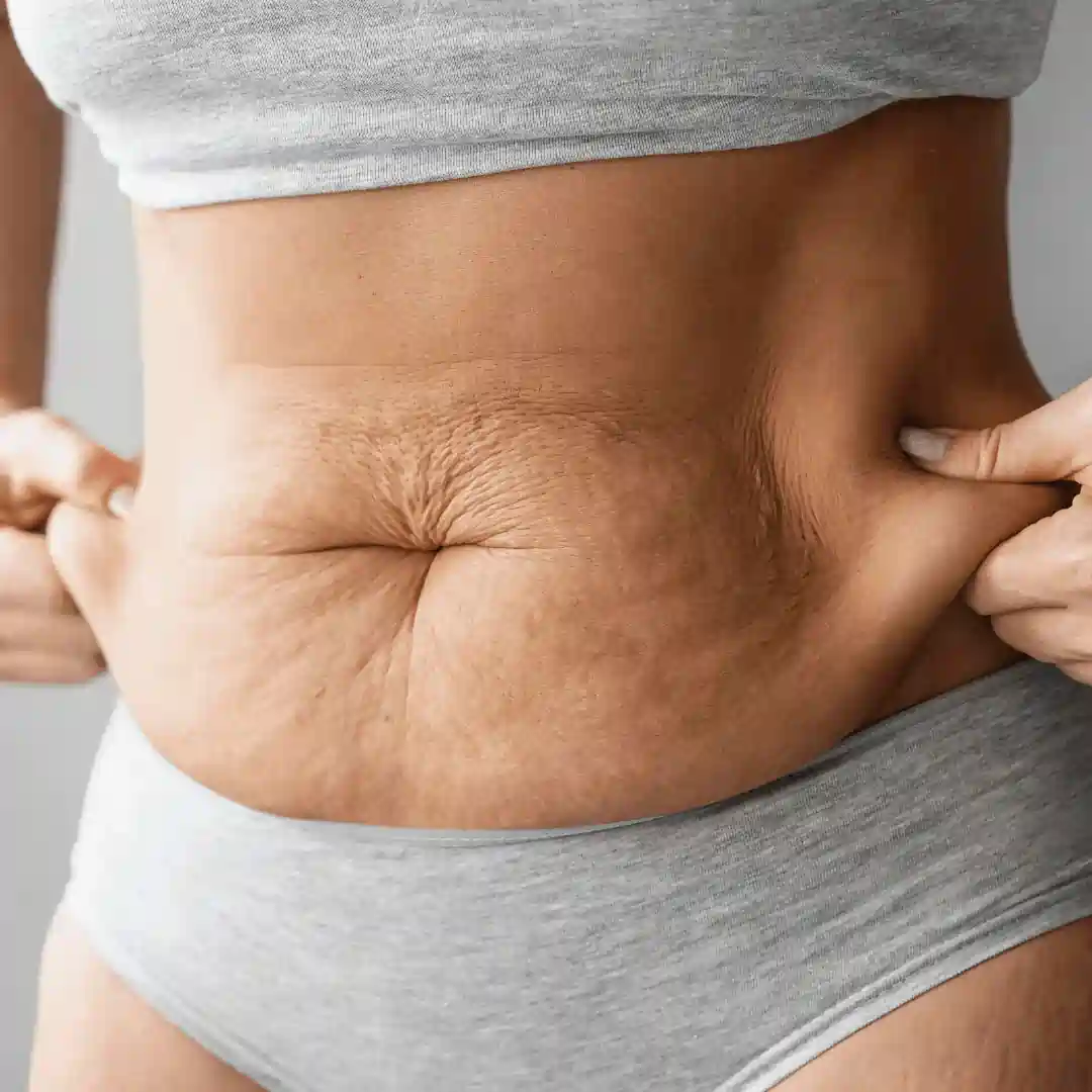 Is It Normal to Have Loose Skin After Pregnancy Wrexham?