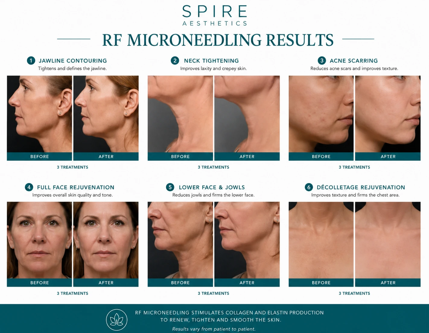 RF Microneedling Skin tightening Wrexham results