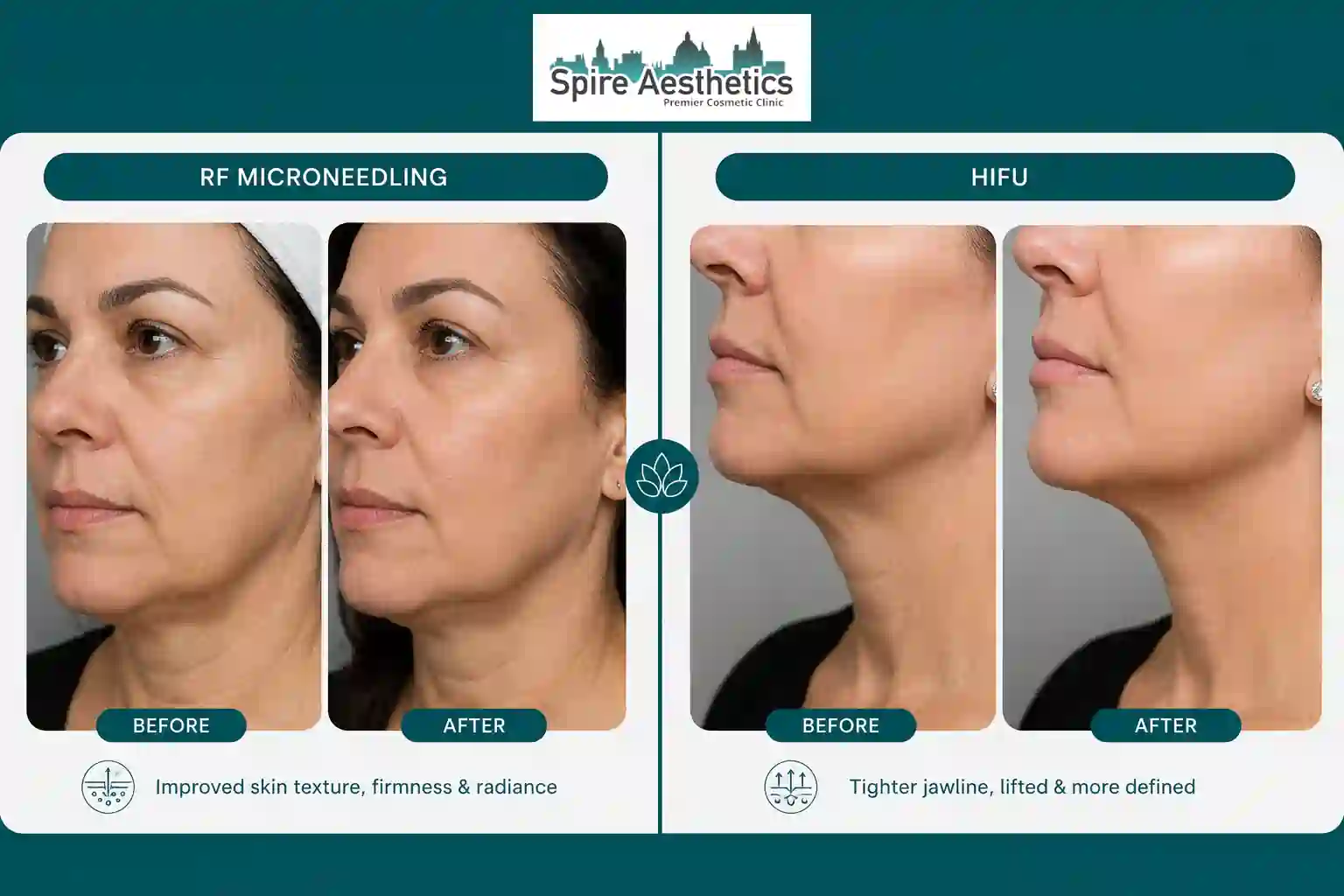 Can RF Microneedling and HIFU Be Combined Wrexham?