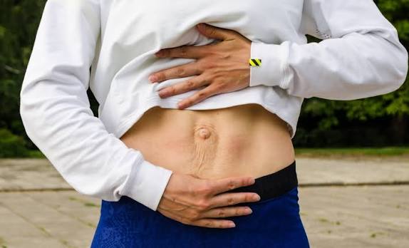 When Could Diastasis Recti Be the Missing Piece of the Puzzle Wrexham?
